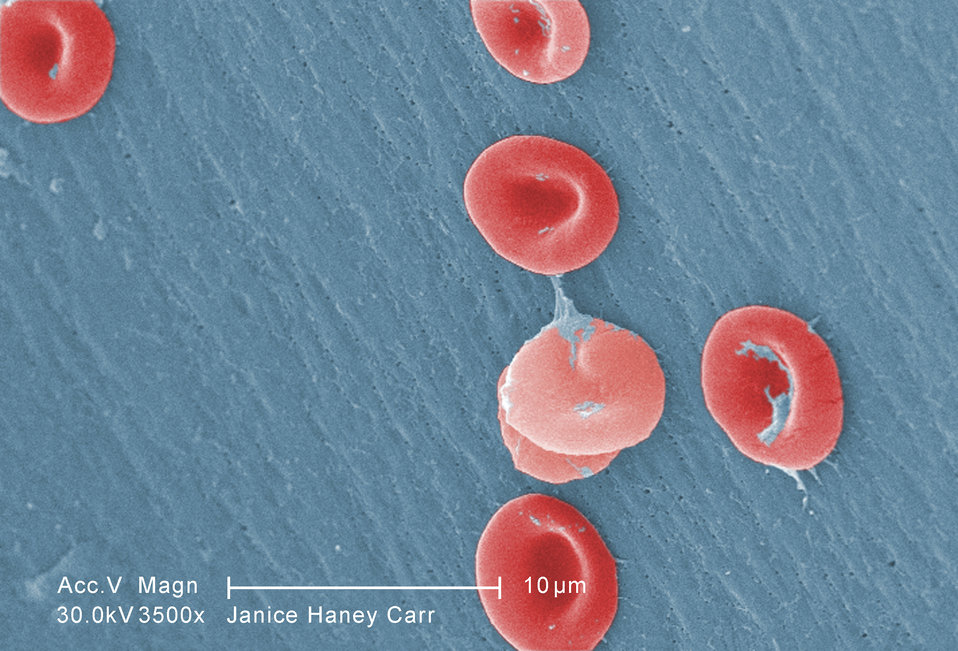 Sickle_Cells.jpg